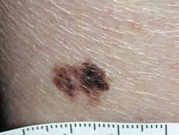 Stage 0 and i are localized, meaning they have not spread. Melanoma Dermnet Nz
