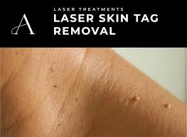 Image result for Skin Tag