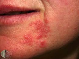 Rote flecken im gesicht können ganz unterschiedliche ursachen haben. Ausschlag Im Gesicht Deximed