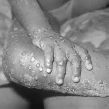 Monkeypox virus causes the disease in both humans and animals. Adh1kc3tnyao2m