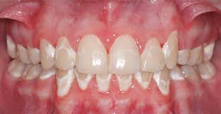 Spark aligners are more clear, more comfortable, stain less and designed for more efficient and effective tooth movement, compared to the leading aligner brand.* Stains On Teeth From Braces Shefalitayal