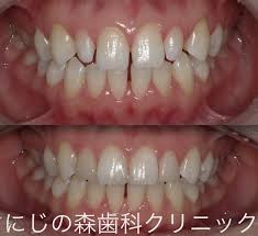 前歯のダイレクトベニア | にじの森歯科クリニック