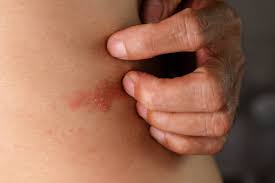 Image result for Varicella zoster on human skin