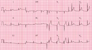 Image result for Early Repolarization