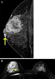 The breast typically becomes red, swollen, and warm with dilation of the pores of the breast skin. Mri Findings Of Inflammatory Breast Cancer Locally Advanced Breast Cancer And Acute Mastitis T2 Weighted Images Can Increase The Specificity Of Inflammatory Breast Cancer Springerlink