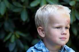 Chichones En Los Ninos Dudas Frecuentes