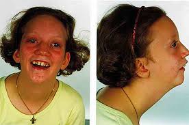 Sindrome di Pierre Robin Sintomi, cause, trattamento