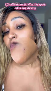 Two steps ahead with @Skincare Lighten series Because having hormonal skin  is a whole battle. One week your face is glowing & the next right before  your period you’re breaking out in ways you can’t ...