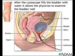 Bladder Wall Interstitial Cystitis Cystitis Reflux Surgery