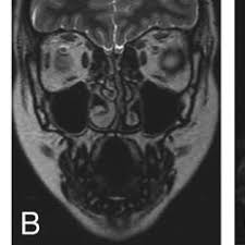 Metal chair near mri machine (simplyphysics.com) 115 points by mikecapone on june 8, 2010 | hide. Pdf Craniofacial Magnetic Resonance Imaging With A Gold Solder Filled Chain Like Wire Fixed Orthodontic Retainer