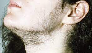 An increase in facial/body hair is called hypertrichosis. Treatment Options For Women With Facial Hair Clinical Advisor