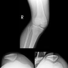 Image result for Patellar Dislocation