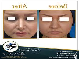 Recovery from surgery can take anywhere from 1 to 3 weeks. Nasal Polyp Removal Surgery Nickelimages