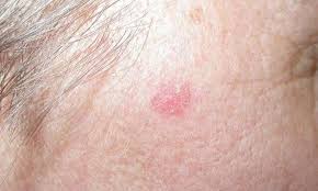 They grow slowly over months or years and rarely spread to other parts of the body. Basal Cell Carcinoma Bcc My Medical Services Australia