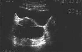 Benign Cystic Mesothelioma Presenting As A Solitary Non Attached Cyst In The Pouch Of Douglas Gynecological Surgery Full Text