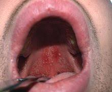 In diesem video berichte ich über die erkrankung stomatitis aphthosa. Mundfaule