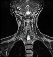 Image result for Syringomyelia