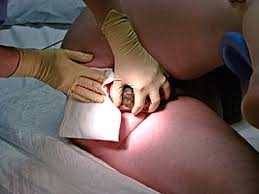 De 30~47% d'épisiotomie moyenne nationale, on passe ici à …0,5 %… en 2016, pour 2900 naissances, 12 épisiotomies ont été faites. Accouchement Normal Procedure Wikimedica