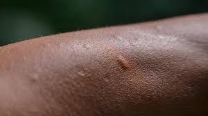 Image result for flea bite