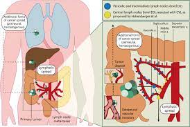 Cancer cells can spread to other parts of the body. More Extensive Lymphadenectomy In Colon Cancer How Far Are We Willing To Go For A Biomarker Springerlink