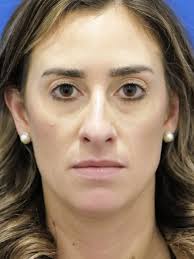 Preservation Rhinoplasty 6721