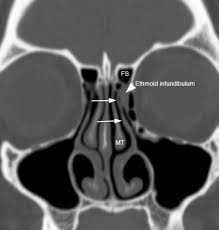 Ethmoid Sinus Abnormal