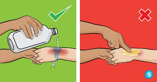 Ozhogi Vidy Pervaya Pomosh Stepeni Vozmozhnye Posledstviya Priznaki Simptomy Lechenie