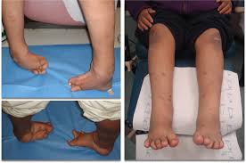 Image result for Clubfoot