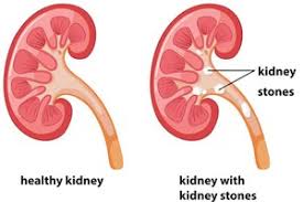Kidney Stones Health Navigator Nz