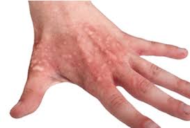 1st degree burn healing process pictures. 6 Mistakes To Avoid With Burn Wounds Advanced Tissue