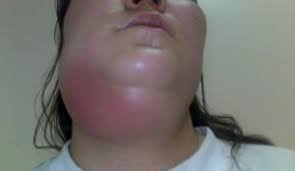 Glandele salivare sunt glande exocrine, care excretă saliva. Chistul Parotid Chistul De RetenÈie Al Glandei Salivare Hioide Formarea Glandei Salivare Hioide