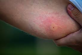Image result for ant bite