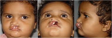UNILATERAL COMPLETE CLEFT LIP REPAIR: A MODERN MORPHO-FUNCTIONAL SURGICAL  APPROACH