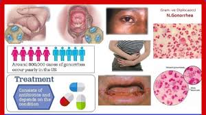Image result for gonorrhea symptoms