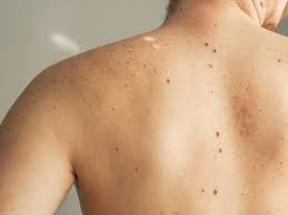 Image result for Freckled skin