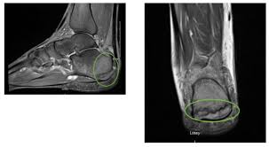 Image result for Calcaneus Compression Fracture