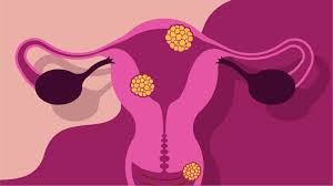 Bacterial vaginosis is a vaginal infection caused by an imbalance in the vaginal fauna which allows bad bacteria to proliferate. Ways To Treat And Prevent Bacterial Vaginosis
