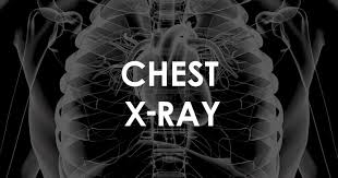 Understand the normal chest x ray. Normal Chest X Ray Litfl Medical Blog Labelled Radiology