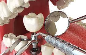 As mentioned, dental insurance is typically offered in three ways: Does Careington Dental Insurance Cover Dental Implants