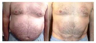 We did not find results for: Diastasis Causes Side Effects Mummy Tummy In Men Too Abdominal Separation Diastasis On Men Diastasis Recti Surgery And More Diastasisrehab News Blog