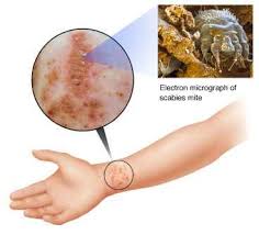 Dengan menggunakan herbal regina, cara menghilangkan kudis buta di tangan perlahan kudis akan sembuh dan hilang secara alami. Tips Merawat Kudis Buta Amynorami Com