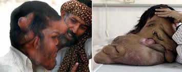 Resultado de imagen para SINDROME DE PROTEUS