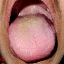 Image result for yellow tongue infection