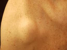 There are a number of different treatments doctors recommend. Metastatic Melanoma Dermnet Nz