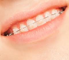 We did not find results for: Clear Braces Ceramic Braces Canberra Embrace Orthodontists