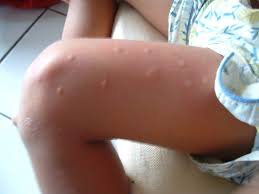 You have fun outdoors or just leave the door open one night and before you know it. How Long Do Mosquito Bites Last Pestseek