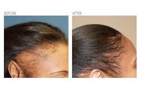 Take internally or apply topically mixed with oil. Hair Regrowth Solution For All Hair Types Contains Pumpkin Seed Extract Msm Vitamin C Biotin Collagen Peptide Hair Regrowth Biotin Hair Growth Biotin Hair