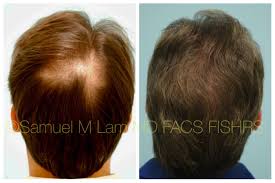 This Gentleman Had Two Hair Transplants Over Time And Is Shown Before And 12 Years Later Hair Transplant Results Hair Transplant Hair