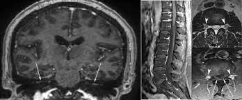 A systematic literature search was performed in pubmed and embase. Magnetic Resonance Imaging Findings In Guillain Barre Syndrome Caused By Zika Virus Infection Springerlink