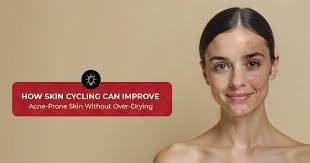 How Skin Cycling Can Improve Acne-Prone Skin Without Over-Drying